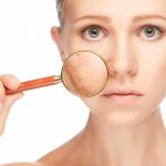 Microdermoabrasion Facial en Guadalajara | Elimina manchas